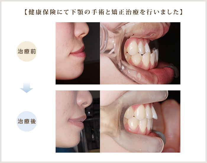 健康保険にて下顎の手術と矯正治療を行いました