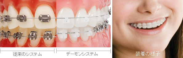 表側からの矯正