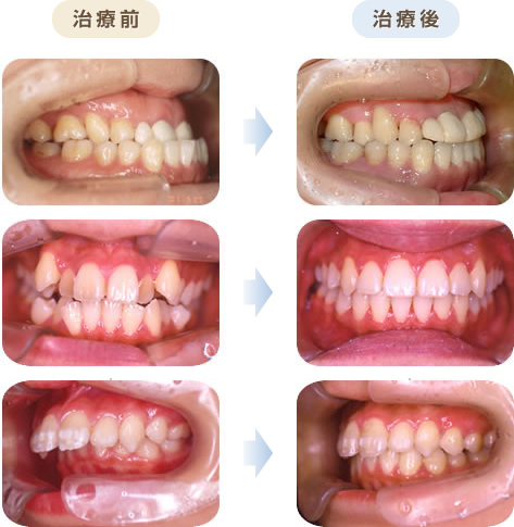 矯正 口元 引っ込み すぎ 抜歯
